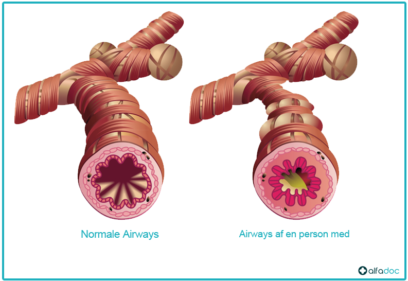 Airways af en person med astma